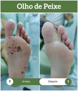 antes-depois-olho-de-peixe-all-pe-sorocaba-clinica-podologia