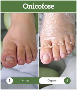 antes-depois-onicofose-all-pe-sorocaba-clinica-podologia