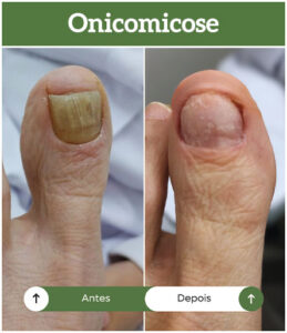 antes-depois-onicomicose-all-pe-sorocaba-clinica-podologia