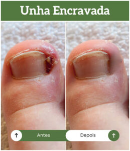 antes-depois-unha-encravada-all-pe-sorocaba-clinica-podologia-2