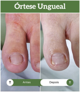 orteses-ungueais-all-pe-sorocaba-clinica-podologia